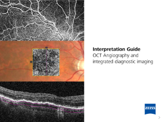 Preview image of Interactive e-Book: OCT Angiography And Integrated Diagnostic Imaging Interpretation Guide