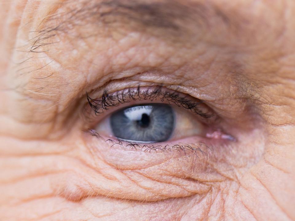 Image showing photoaging  around the eyes.